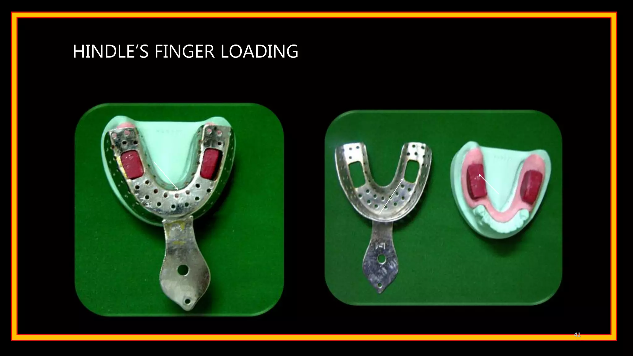 HINDLE’S FINGER LOADING
41
 