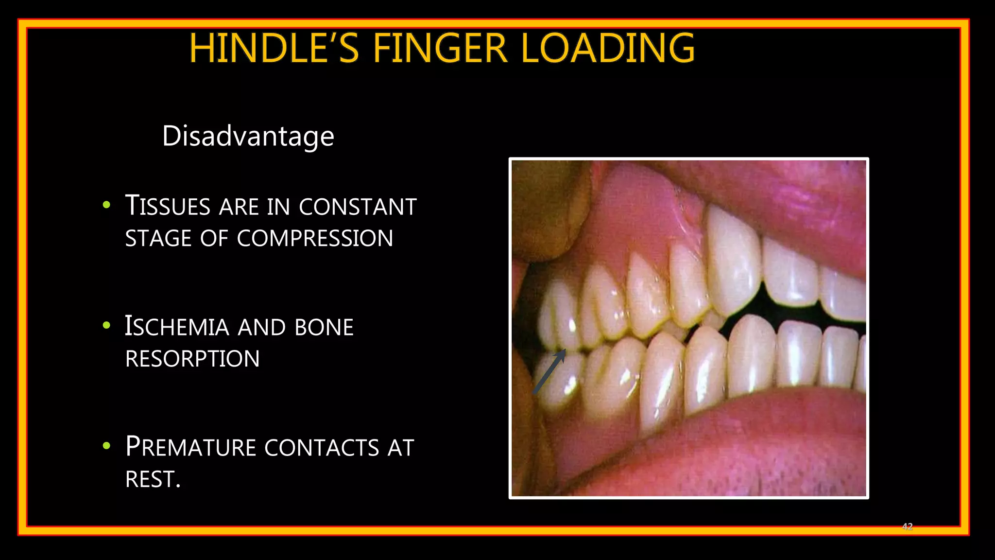 HINDLE’S FINGER LOADING
• TISSUES ARE IN CONSTANT
STAGE OF COMPRESSION
• ISCHEMIA AND BONE
RESORPTION
• PREMATURE CONTACTS AT
REST.
42
Disadvantage
 