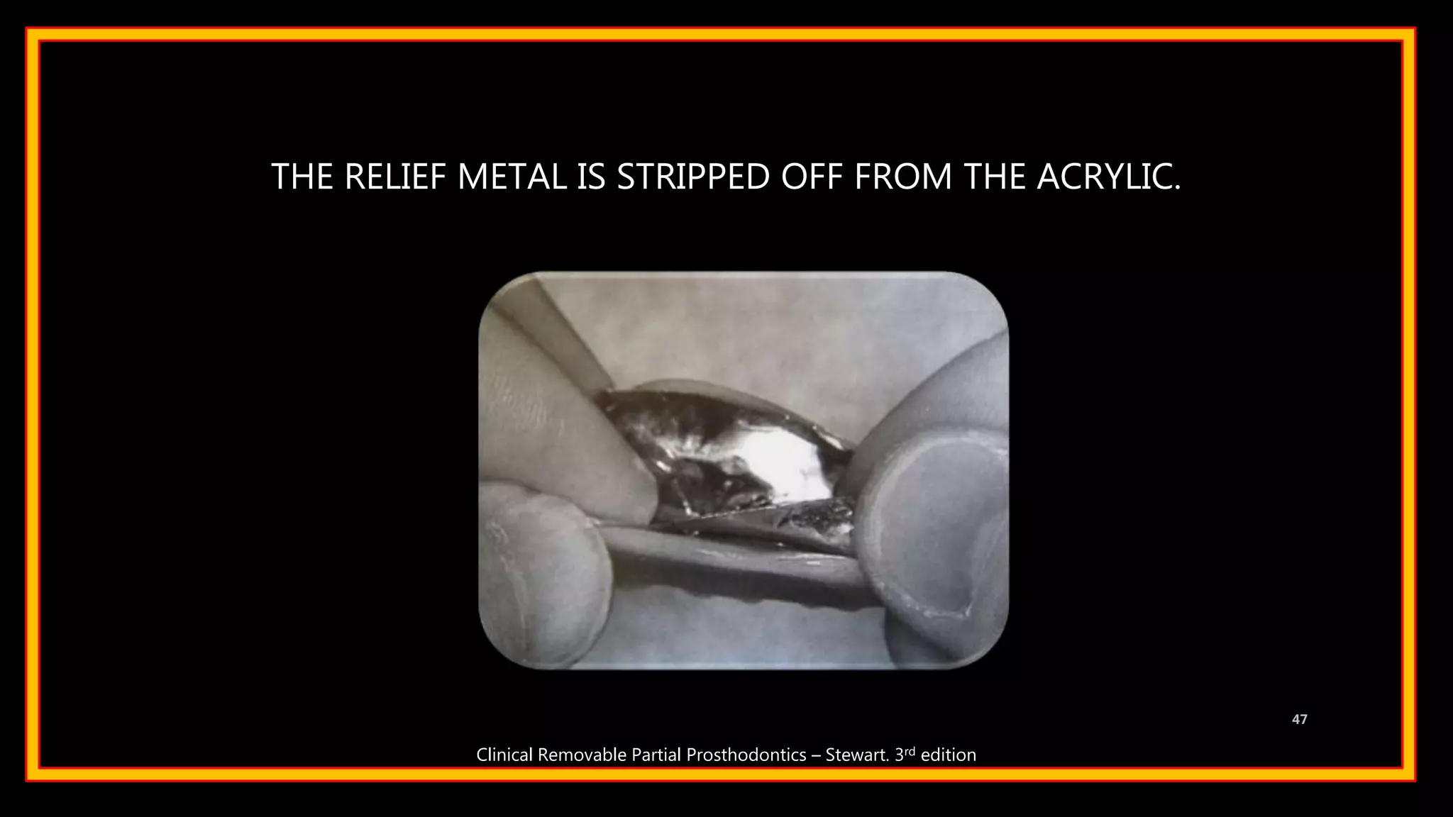 THE RELIEF METAL IS STRIPPED OFF FROM THE ACRYLIC.
47
Clinical Removable Partial Prosthodontics – Stewart. 3rd edition
 