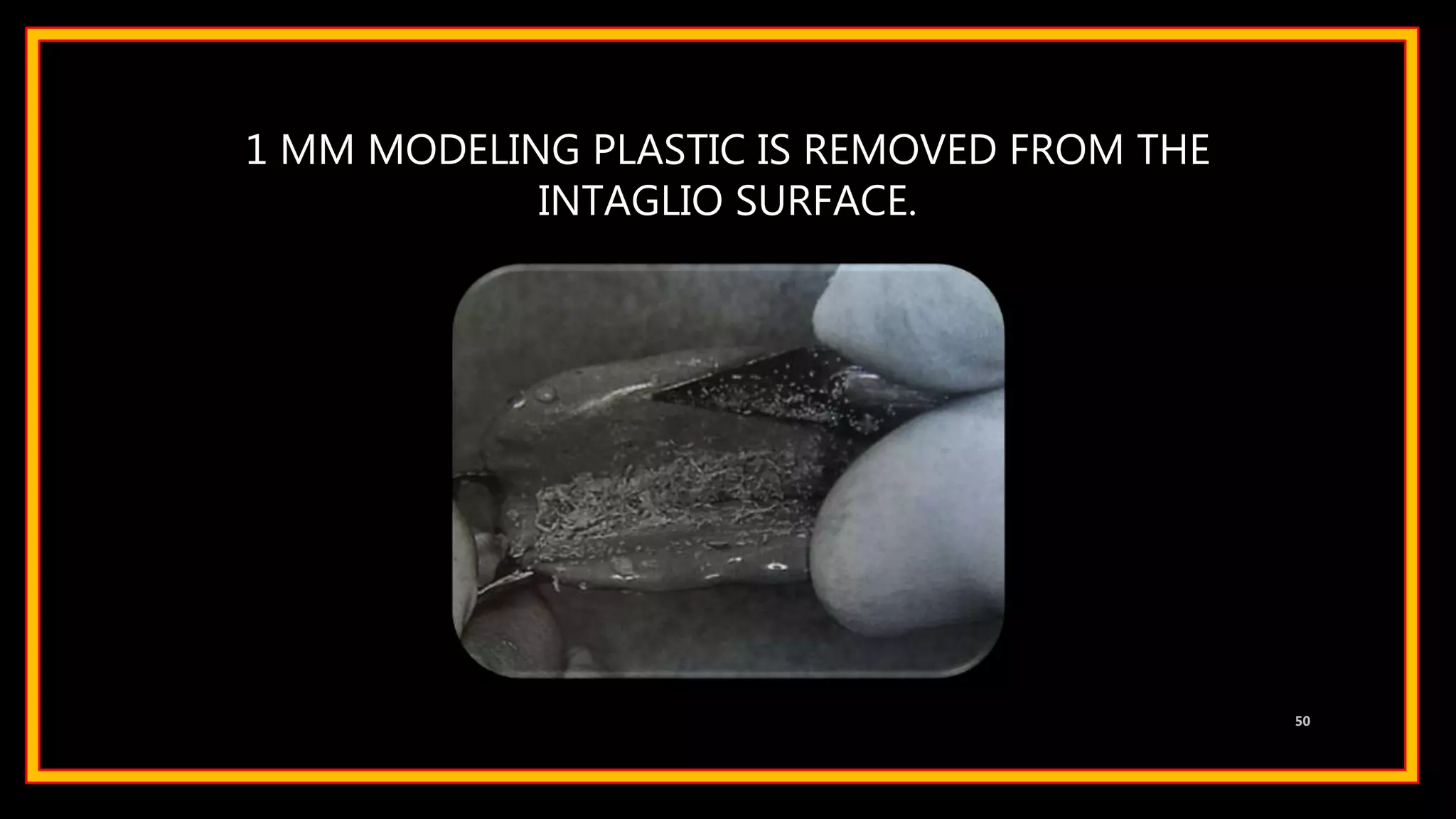 1 MM MODELING PLASTIC IS REMOVED FROM THE
INTAGLIO SURFACE.
50
 