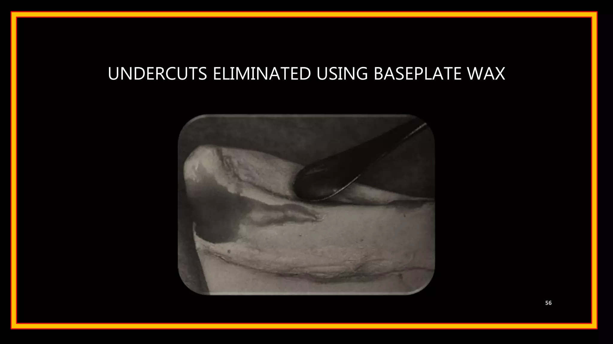 UNDERCUTS ELIMINATED USING BASEPLATE WAX
56
 