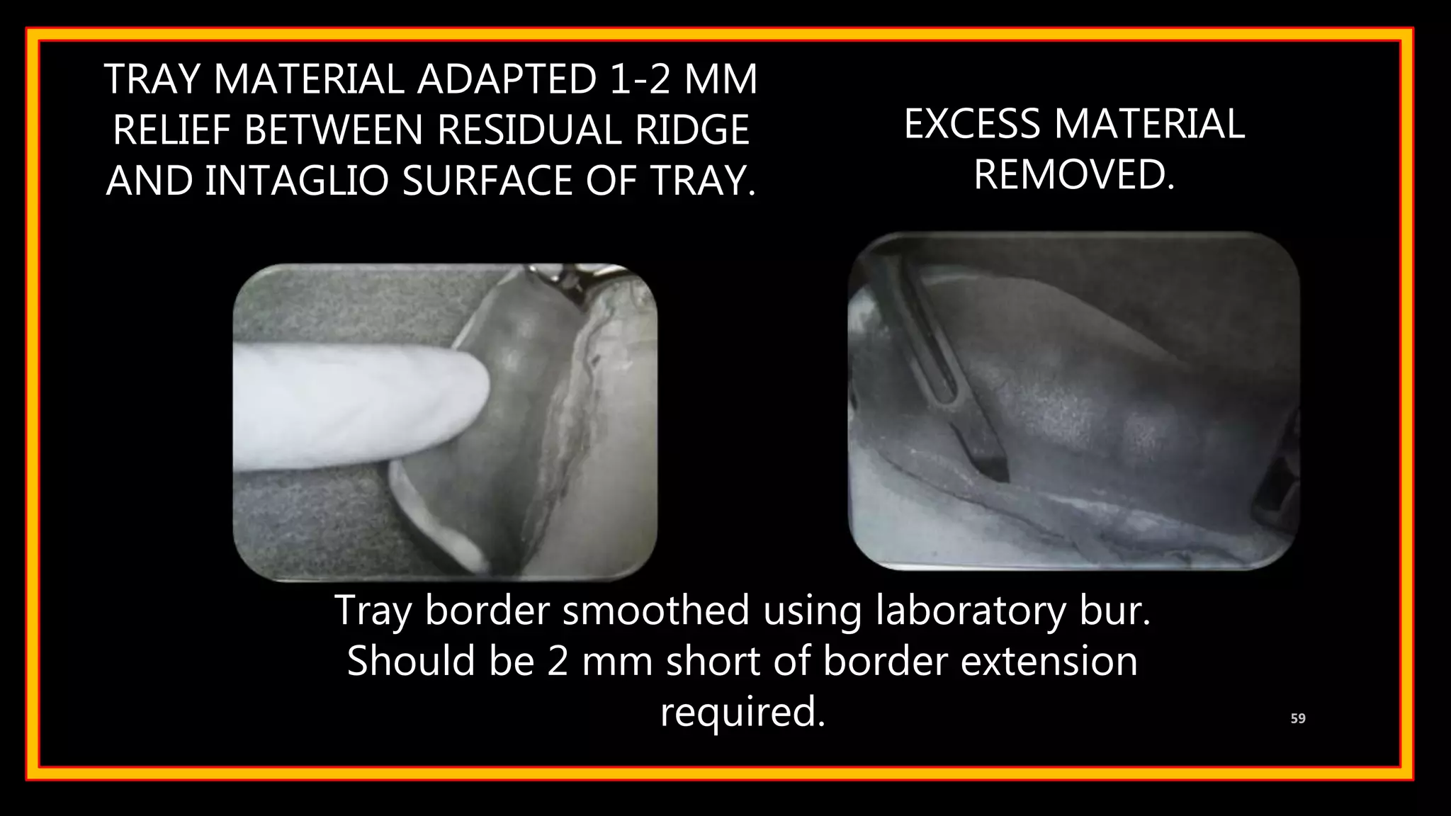 TRAY MATERIAL ADAPTED 1-2 MM
RELIEF BETWEEN RESIDUAL RIDGE
AND INTAGLIO SURFACE OF TRAY.
59
EXCESS MATERIAL
REMOVED.
Tray border smoothed using laboratory bur.
Should be 2 mm short of border extension
required.
 