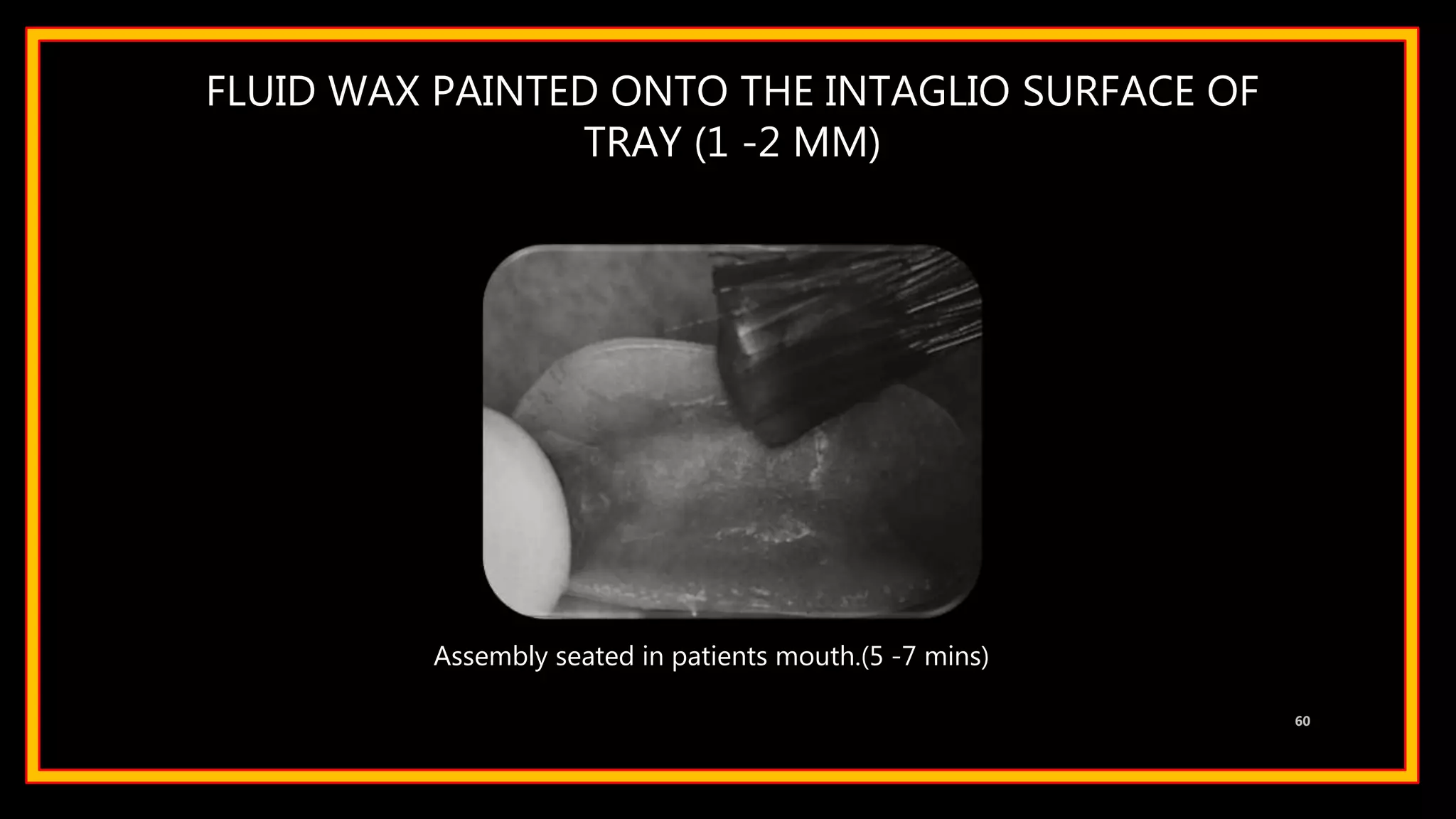 FLUID WAX PAINTED ONTO THE INTAGLIO SURFACE OF
TRAY (1 -2 MM)
60
Assembly seated in patients mouth.(5 -7 mins)
 
