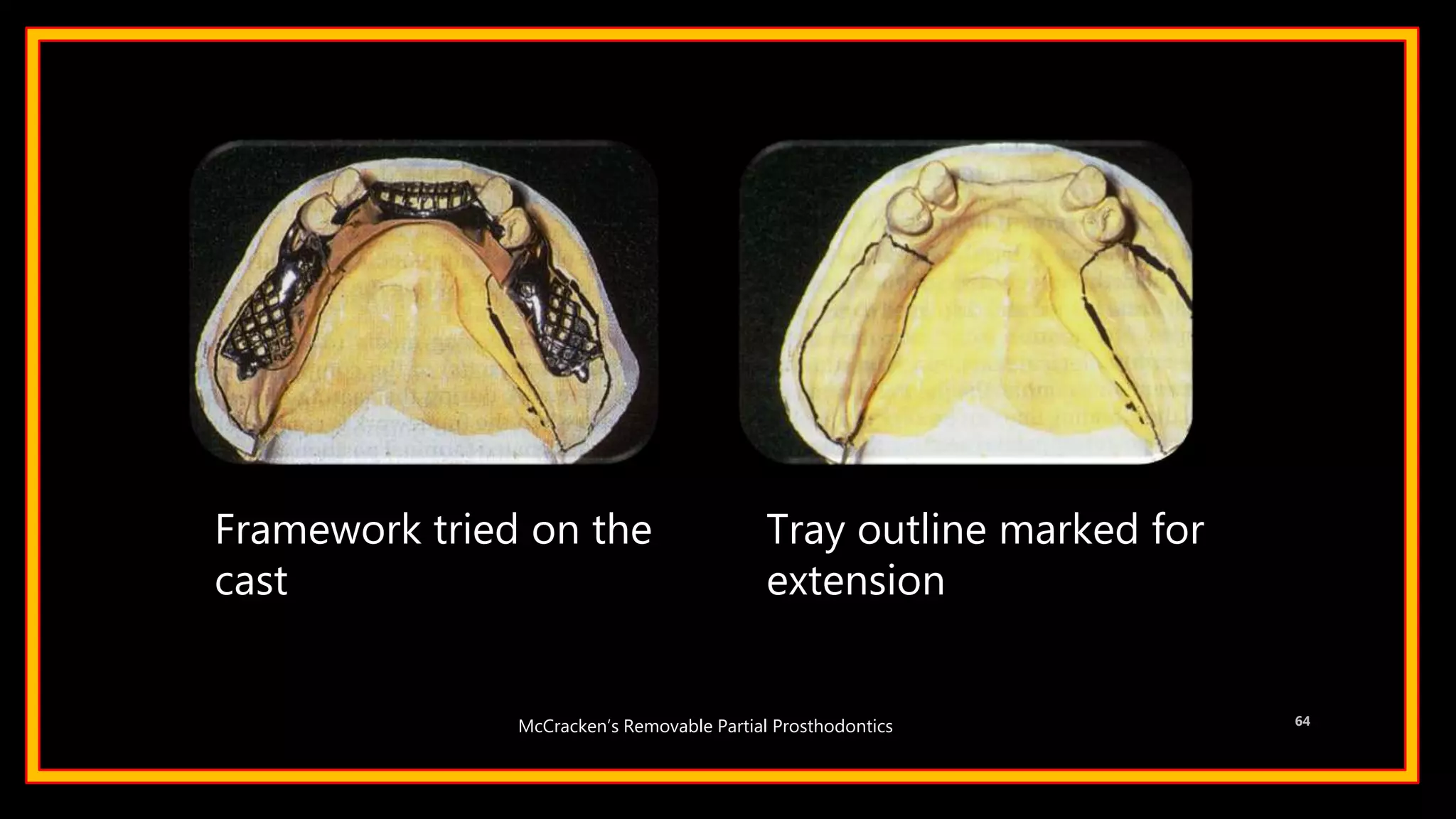 Framework tried on the
cast
Tray outline marked for
extension
64McCracken’s Removable Partial Prosthodontics
 