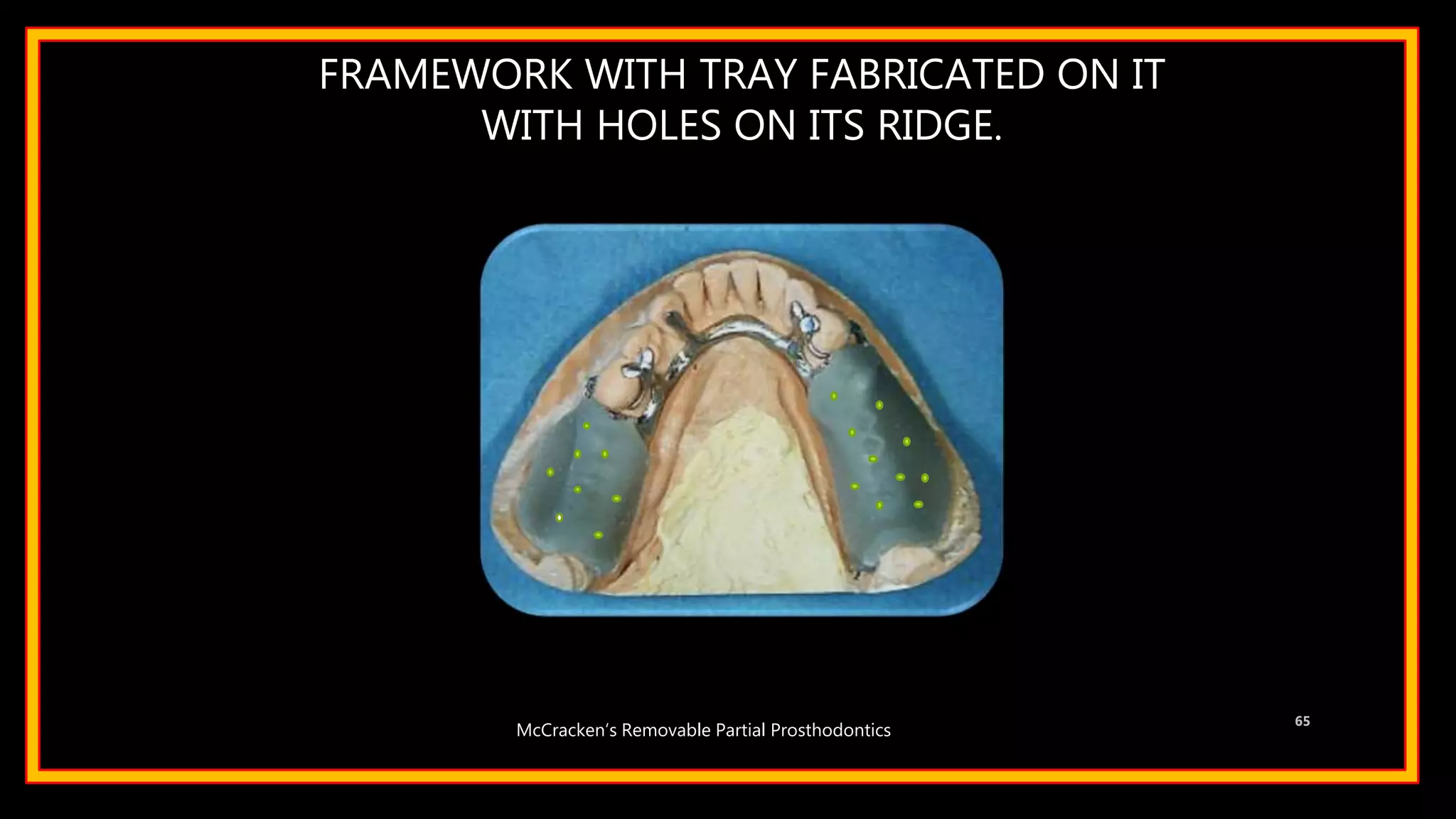 FRAMEWORK WITH TRAY FABRICATED ON IT
WITH HOLES ON ITS RIDGE.
65
McCracken’s Removable Partial Prosthodontics
 
