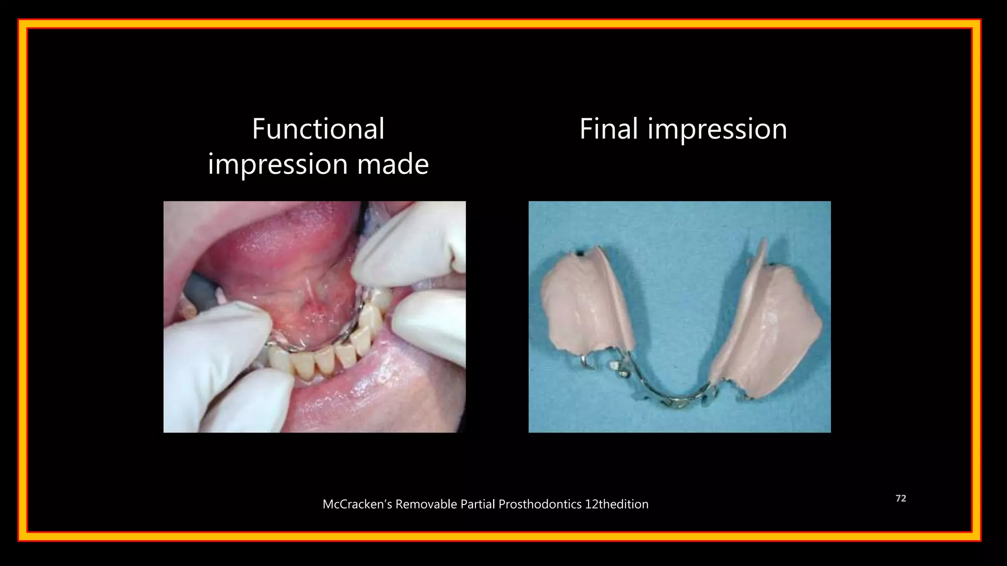 Functional
impression made
Final impression
72
McCracken’s Removable Partial Prosthodontics 12thedition
 