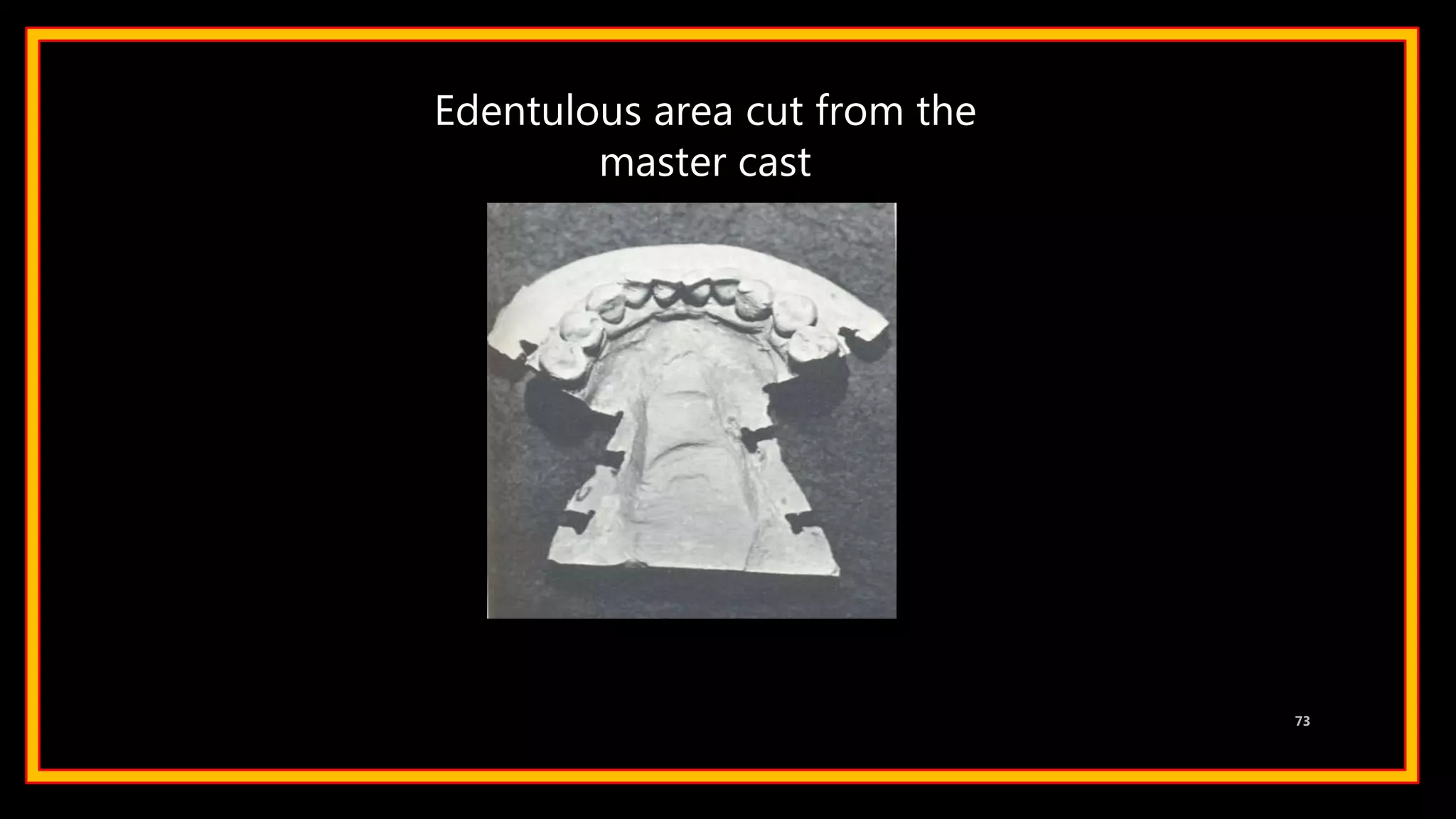 Edentulous area cut from the
master cast
73
 
