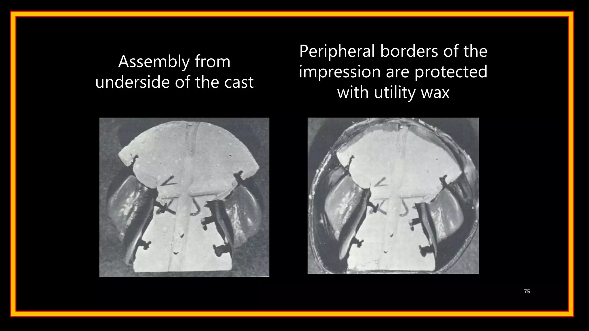 Assembly from
underside of the cast
Peripheral borders of the
impression are protected
with utility wax
75
 