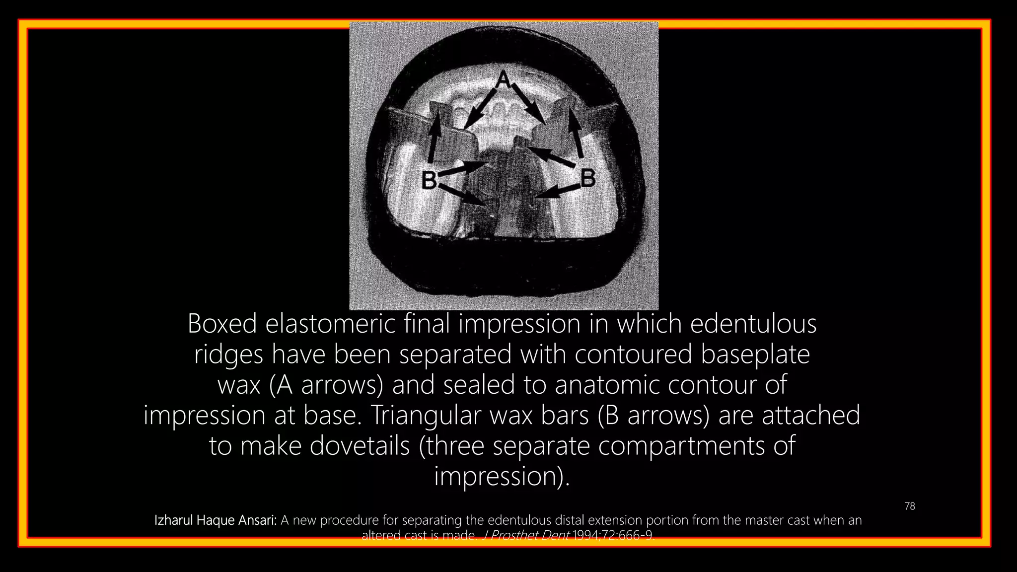 78
Boxed elastomeric final impression in which edentulous
ridges have been separated with contoured baseplate
wax (A arrows) and sealed to anatomic contour of
impression at base. Triangular wax bars (B arrows) are attached
to make dovetails (three separate compartments of
impression).
Izharul Haque Ansari: A new procedure for separating the edentulous distal extension portion from the master cast when an
altered cast is made. J Prosthet Dent 1994;72:666-9.
 