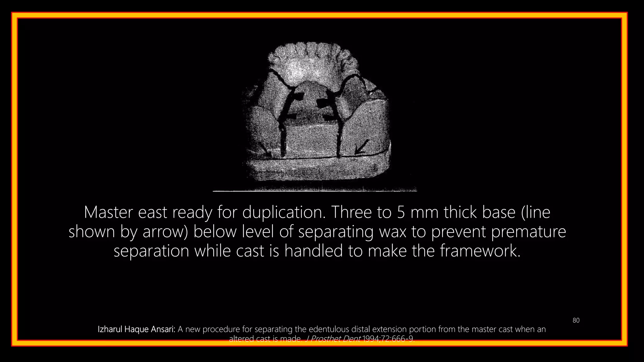 80
Master east ready for duplication. Three to 5 mm thick base (line
shown by arrow) below level of separating wax to prevent premature
separation while cast is handled to make the framework.
Izharul Haque Ansari: A new procedure for separating the edentulous distal extension portion from the master cast when an
altered cast is made. J Prosthet Dent 1994;72:666-9.
 