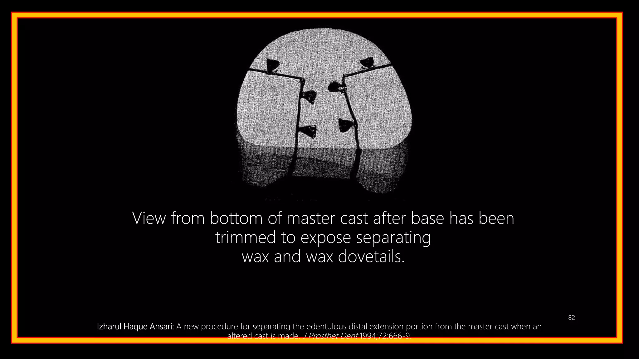 82
View from bottom of master cast after base has been
trimmed to expose separating
wax and wax dovetails.
Izharul Haque Ansari: A new procedure for separating the edentulous distal extension portion from the master cast when an
altered cast is made. J Prosthet Dent 1994;72:666-9.
 