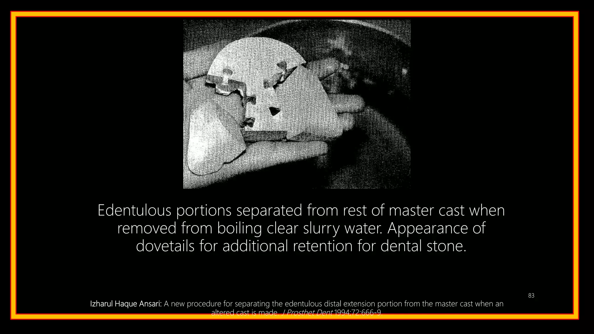 83
Edentulous portions separated from rest of master cast when
removed from boiling clear slurry water. Appearance of
dovetails for additional retention for dental stone.
Izharul Haque Ansari: A new procedure for separating the edentulous distal extension portion from the master cast when an
altered cast is made. J Prosthet Dent 1994;72:666-9.
 