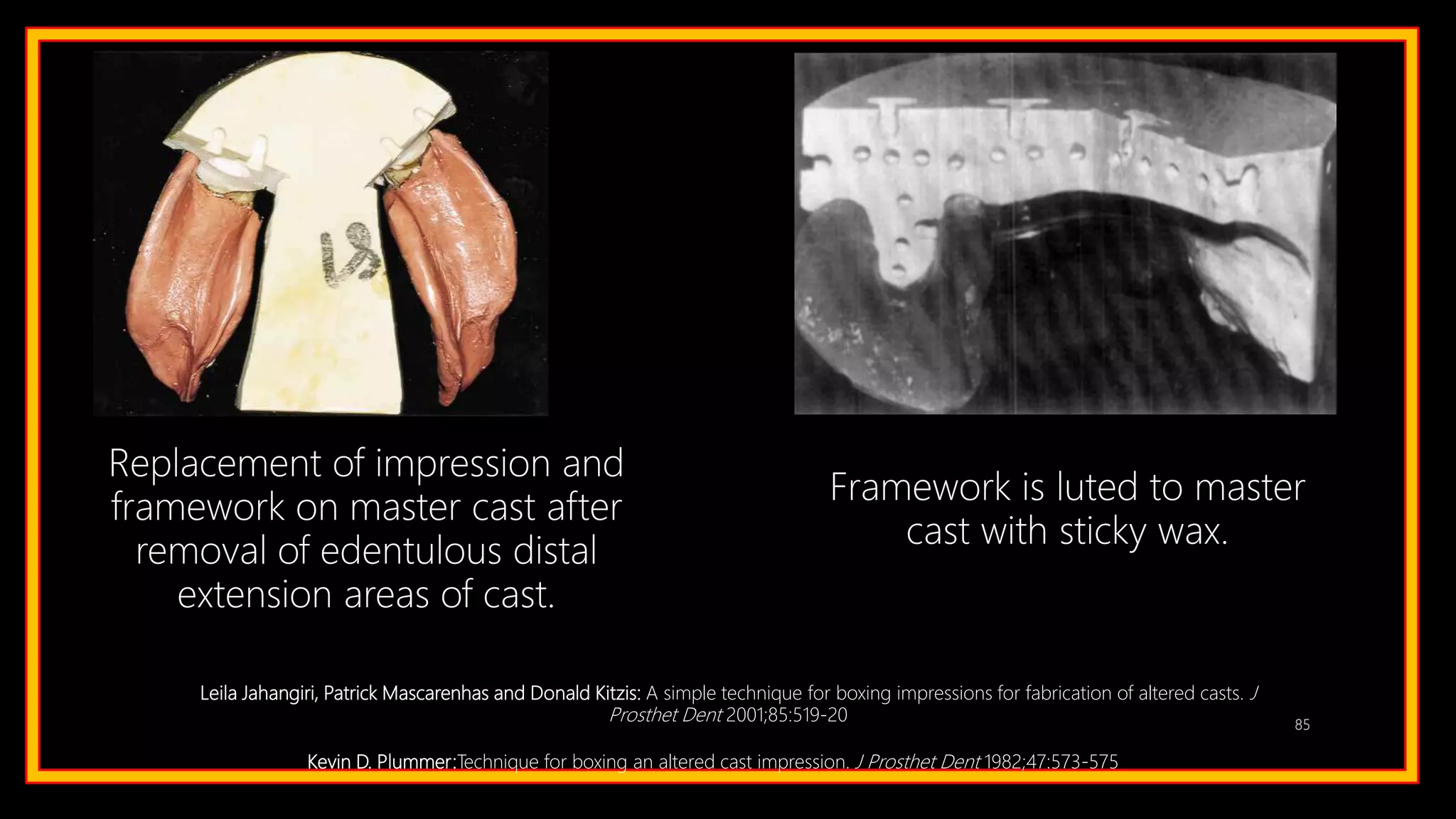 85
Replacement of impression and
framework on master cast after
removal of edentulous distal
extension areas of cast.
Framework is luted to master
cast with sticky wax.
Leila Jahangiri, Patrick Mascarenhas and Donald Kitzis: A simple technique for boxing impressions for fabrication of altered casts. J
Prosthet Dent 2001;85:519-20
Kevin D. Plummer:Technique for boxing an altered cast impression. J Prosthet Dent 1982;47:573-575
 
