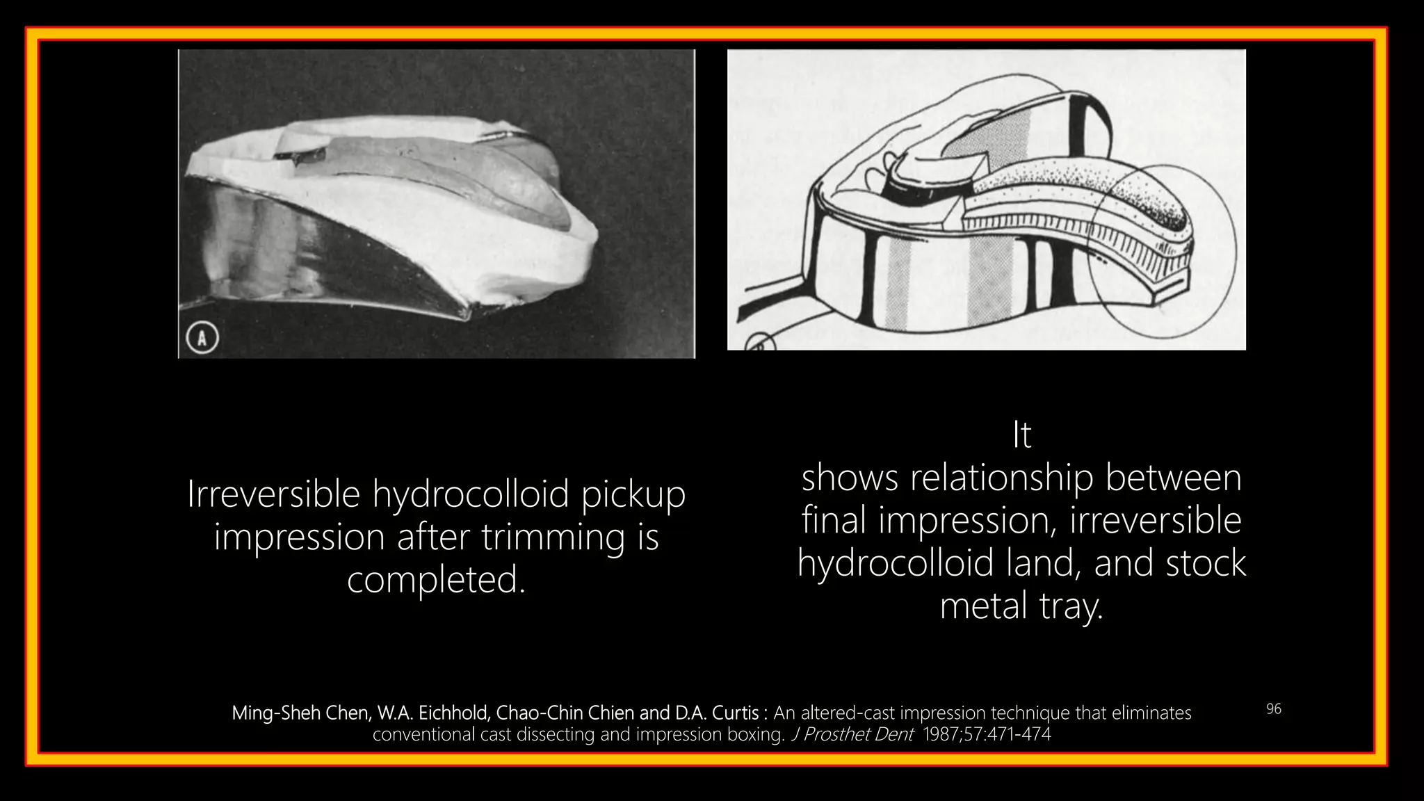 96
Irreversible hydrocolloid pickup
impression after trimming is
completed.
It
shows relationship between
final impression, irreversible
hydrocolloid land, and stock
metal tray.
Ming-Sheh Chen, W.A. Eichhold, Chao-Chin Chien and D.A. Curtis : An altered-cast impression technique that eliminates
conventional cast dissecting and impression boxing. J Prosthet Dent 1987;57:471-474
 
