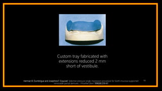 102Herman B. Dumbrigue and Josephine F. Esquivel: Selective-pressure single impression procedure for tooth-mucosa–supported
removable partial dentures. J Prosthet Dent 1998;80:259-61
Custom tray fabricated with
extensions reduced 2 mm
short of vestibule.
 