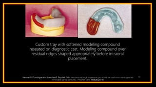 103Herman B. Dumbrigue and Josephine F. Esquivel: Selective-pressure single impression procedure for tooth-mucosa–supported
removable partial dentures. J Prosthet Dent 1998;80:259-61
Custom tray with softened modeling compound
reseated on diagnostic cast. Modeling compound over
residual ridges shaped appropriately before intraoral
placement.
 