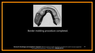 104Herman B. Dumbrigue and Josephine F. Esquivel: Selective-pressure single impression procedure for tooth-mucosa–supported
removable partial dentures. J Prosthet Dent 1998;80:259-61
Border molding procedure completed.
 
