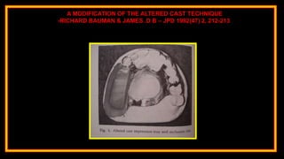 A MODIFICATION OF THE ALTERED CAST TECHNIQUE
-RICHARD BAUMAN & JAMES .D B – JPD 1982(47) 2, 212-213
 