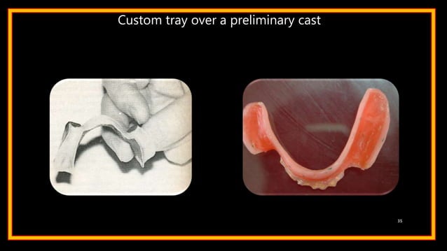 Impression techniques in rpd | PPTX