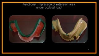 36
Functional impression of extension area
under occlusal load
 