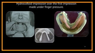 Hydrocolloid impression over the first impression
made under finger pressure.
37
 