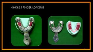 HINDLE’S FINGER LOADING
41
 