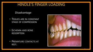 HINDLE’S FINGER LOADING
• TISSUES ARE IN CONSTANT
STAGE OF COMPRESSION
• ISCHEMIA AND BONE
RESORPTION
• PREMATURE CONTACTS AT
REST.
42
Disadvantage
 