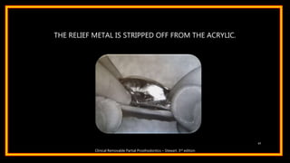 THE RELIEF METAL IS STRIPPED OFF FROM THE ACRYLIC.
47
Clinical Removable Partial Prosthodontics – Stewart. 3rd edition
 