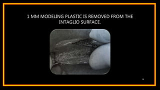 1 MM MODELING PLASTIC IS REMOVED FROM THE
INTAGLIO SURFACE.
50
 