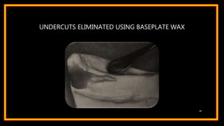 UNDERCUTS ELIMINATED USING BASEPLATE WAX
56
 