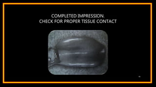COMPLETED IMPRESSION.
CHECK FOR PROPER TISSUE CONTACT
61
 