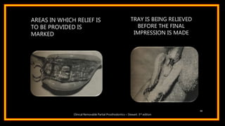 AREAS IN WHICH RELIEF IS
TO BE PROVIDED IS
MARKED
66
TRAY IS BEING RELIEVED
BEFORE THE FINAL
IMPRESSION IS MADE
Clinical Removable Partial Prosthodontics – Stewart. 3rd edition
 