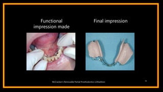 Functional
impression made
Final impression
72
McCracken’s Removable Partial Prosthodontics 12thedition
 