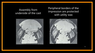 Assembly from
underside of the cast
Peripheral borders of the
impression are protected
with utility wax
75
 
