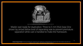 80
Master east ready for duplication. Three to 5 mm thick base (line
shown by arrow) below level of separating wax to prevent premature
separation while cast is handled to make the framework.
Izharul Haque Ansari: A new procedure for separating the edentulous distal extension portion from the master cast when an
altered cast is made. J Prosthet Dent 1994;72:666-9.
 
