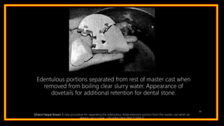 83
Edentulous portions separated from rest of master cast when
removed from boiling clear slurry water. Appearance of
dovetails for additional retention for dental stone.
Izharul Haque Ansari: A new procedure for separating the edentulous distal extension portion from the master cast when an
altered cast is made. J Prosthet Dent 1994;72:666-9.
 