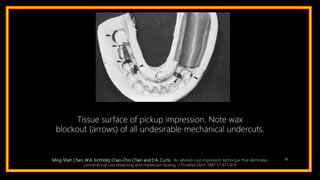 98
Tissue surface of pickup impression. Note wax
blockout (arrows) of all undesirable mechanical undercuts.
Ming-Sheh Chen, W.A. Eichhold, Chao-Chin Chien and D.A. Curtis : An altered-cast impression technique that eliminates
conventional cast dissecting and impression boxing. J Prosthet Dent 1987;57:471-474
 