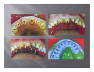 Impression techniques | PDF