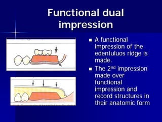 Impression techniques and materials partial dentures yr 3 | PDF