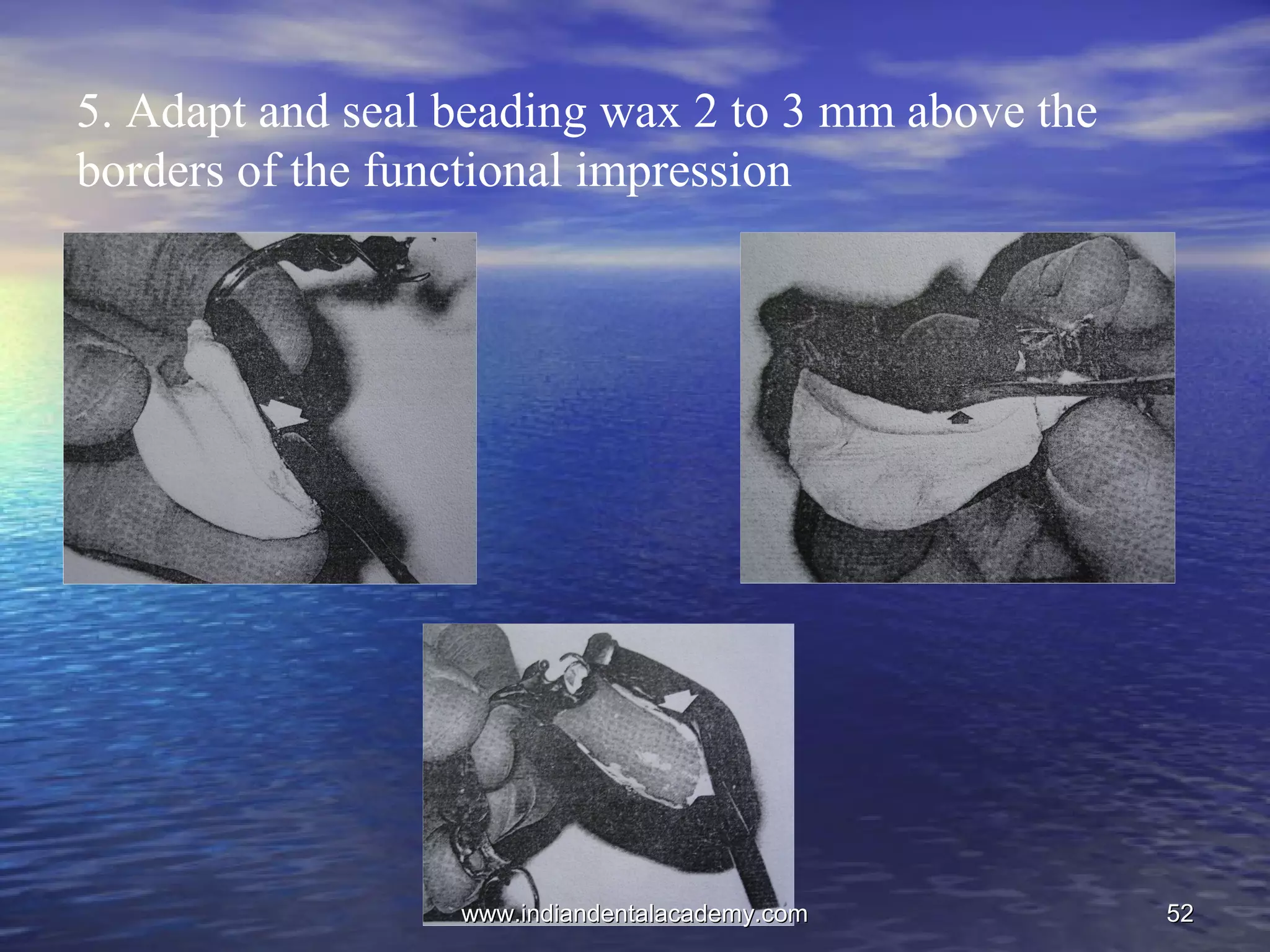 5252
5. Adapt and seal beading wax 2 to 3 mm above the
borders of the functional impression
www.indiandentalacademy.comwww.indiandentalacademy.com
 