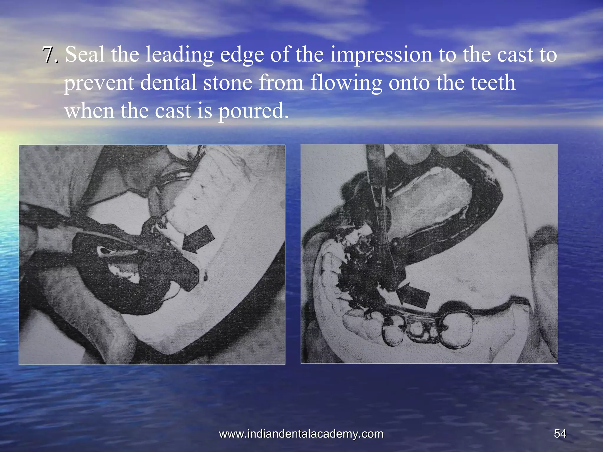 5454
7.7. Seal the leading edge of the impression to the cast to
prevent dental stone from flowing onto the teeth
when the cast is poured.
www.indiandentalacademy.comwww.indiandentalacademy.com
 