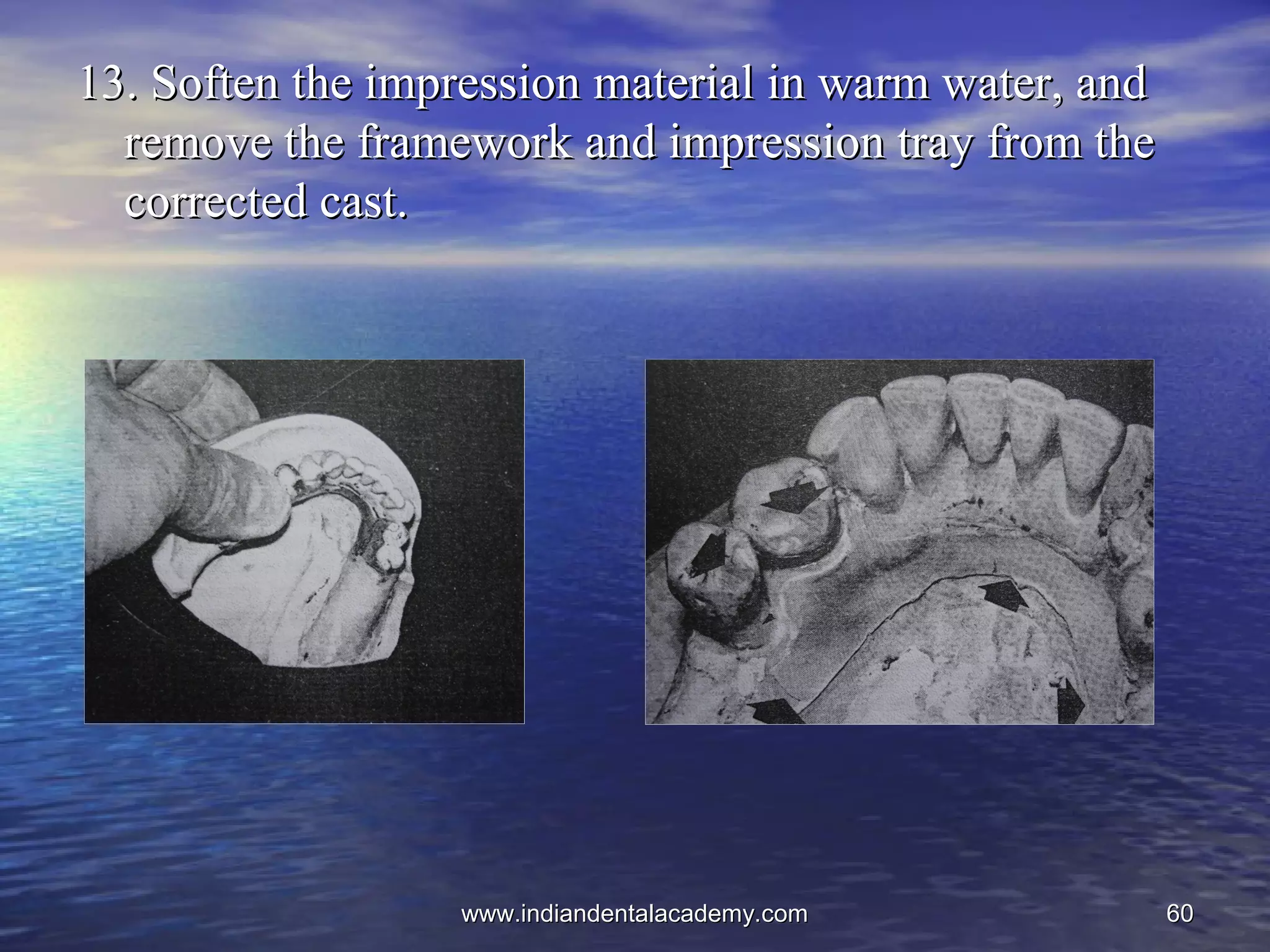 6060
13.13. Soften the impressionSoften the impression material in warm water, andmaterial in warm water, and
remove the framework and impression tray from theremove the framework and impression tray from the
corrected cast.corrected cast.
www.indiandentalacademy.comwww.indiandentalacademy.com
 