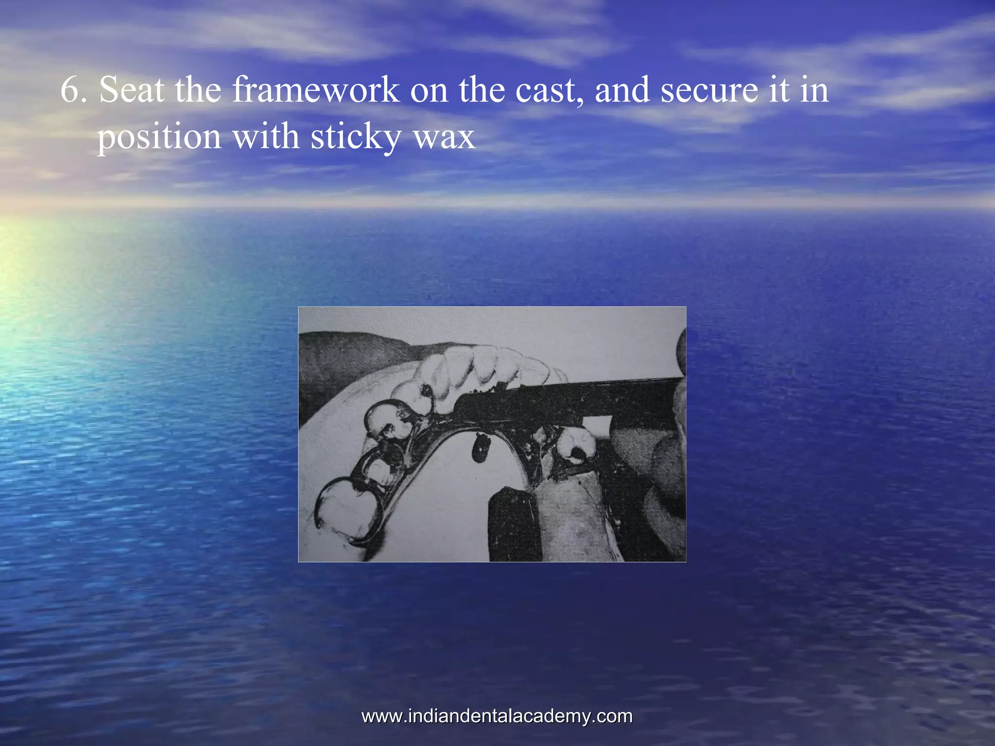 6. Seat the framework on the cast, and secure it in
position with sticky wax
www.indiandentalacademy.comwww.indiandentalacademy.com
 