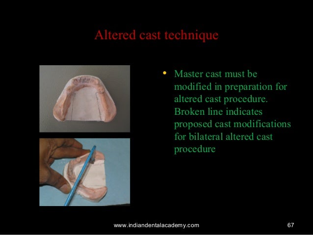 impression techniques for rpd implant dentistry course altered cast technique