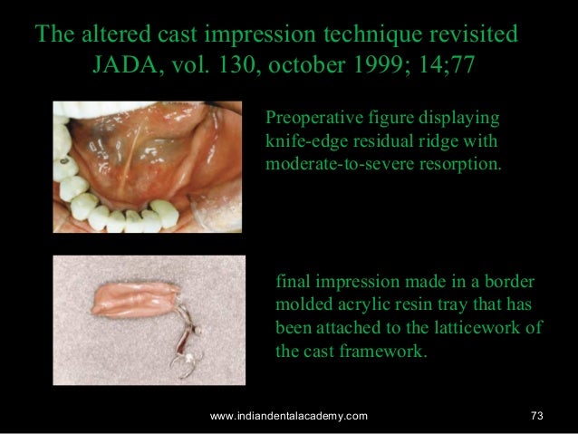 impression techniques for rpd implant dentistry course altered cast technique