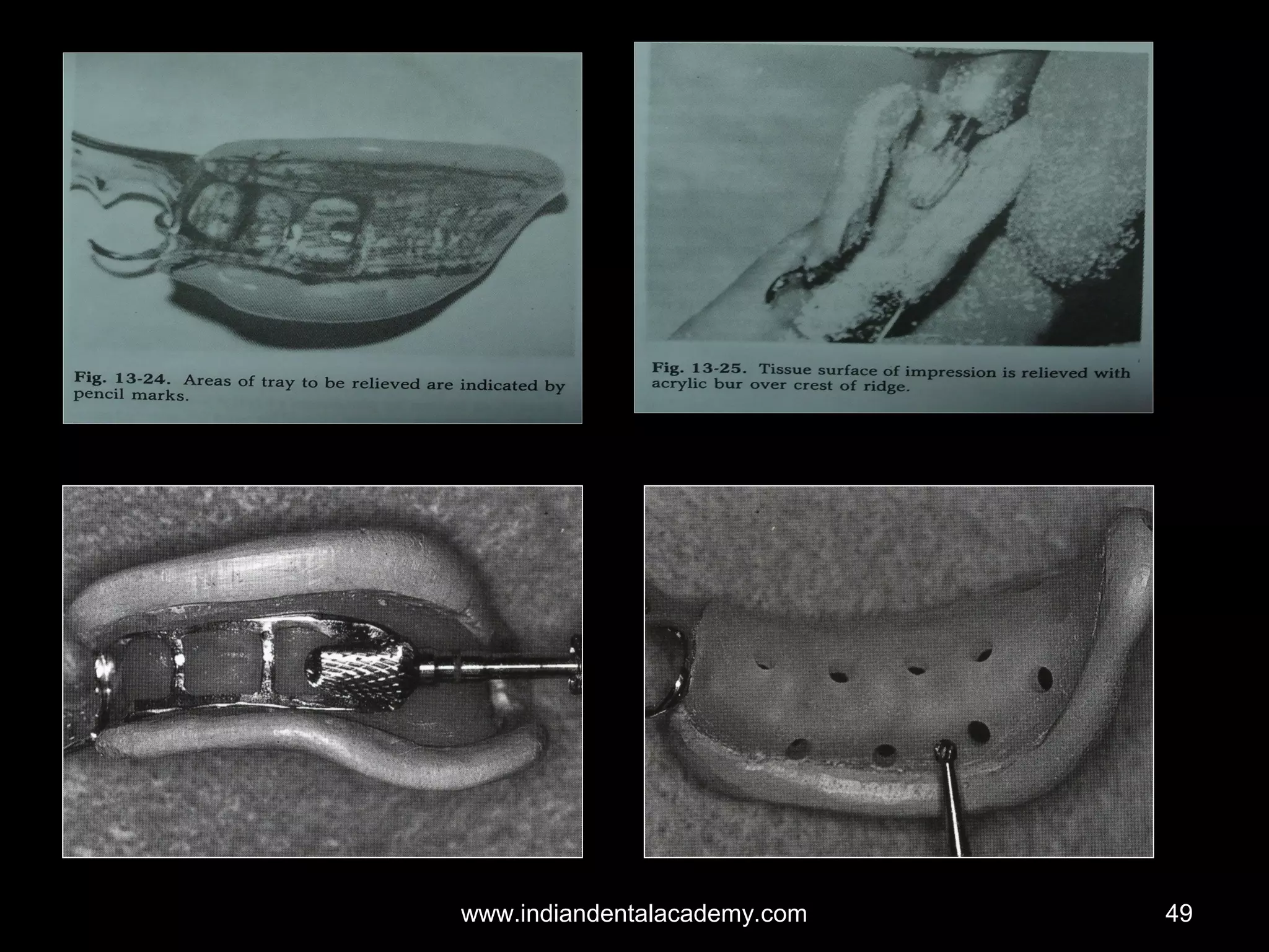 Impression techniques for rpd / dental crown & bridge courses