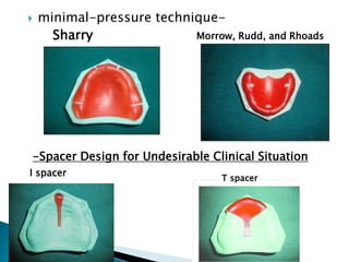  minimal-pressure technique-
Sharry Morrow, Rudd, and Rhoads
-Spacer Design for Undesirable Clinical Situation
I spacer
T spacer
 