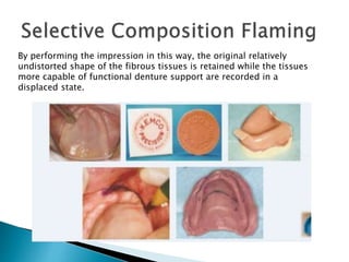 By performing the impression in this way, the original relatively
undistorted shape of the fibrous tissues is retained while the tissues
more capable of functional denture support are recorded in a
displaced state.
 