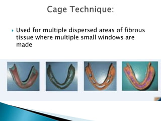  Used for multiple dispersed areas of fibrous
tissue where multiple small windows are
made
 