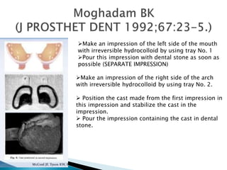 Make an impression of the left side of the mouth
with irreversible hydrocolloid by using tray No. 1
Pour this impression with dental stone as soon as
possible (SEPARATE IMPRESSION)
Make an impression of the right side of the arch
with irreversible hydrocolloid by using tray No. 2.
 Position the cast made from the first impression in
this impression and stabilize the cast in the
impression.
 Pour the impression containing the cast in dental
stone.
 